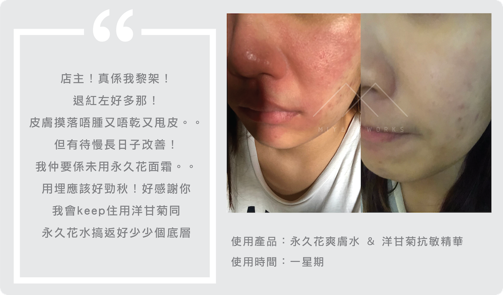 使用永久花爽膚水洋甘菊精華改善泛紅皮膚回復平滑