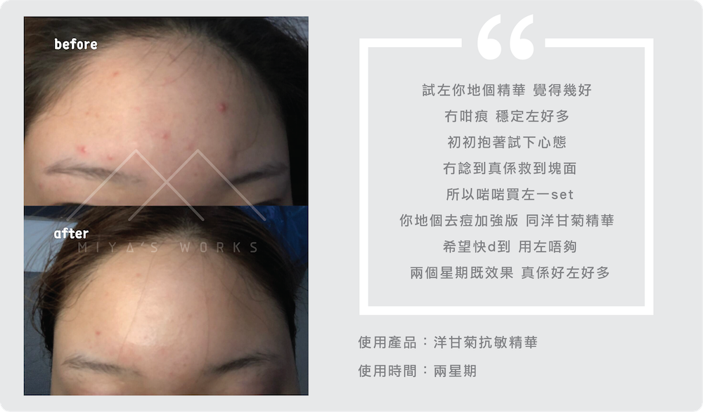 使用洋甘菊精華皮膚穩定舒緩痕癢