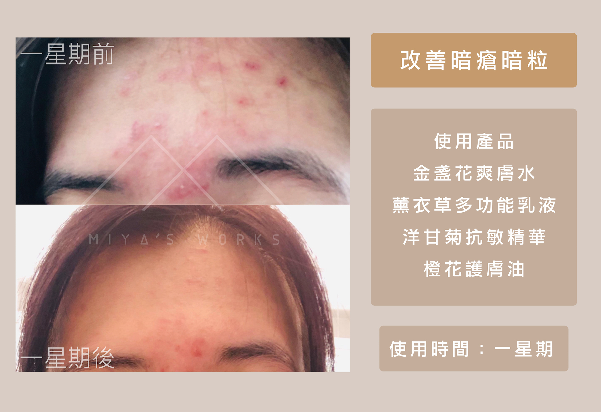 使用金盞花爽膚水薰衣草乳液洋甘菊精華橙花護膚油改善暗瘡暗粒