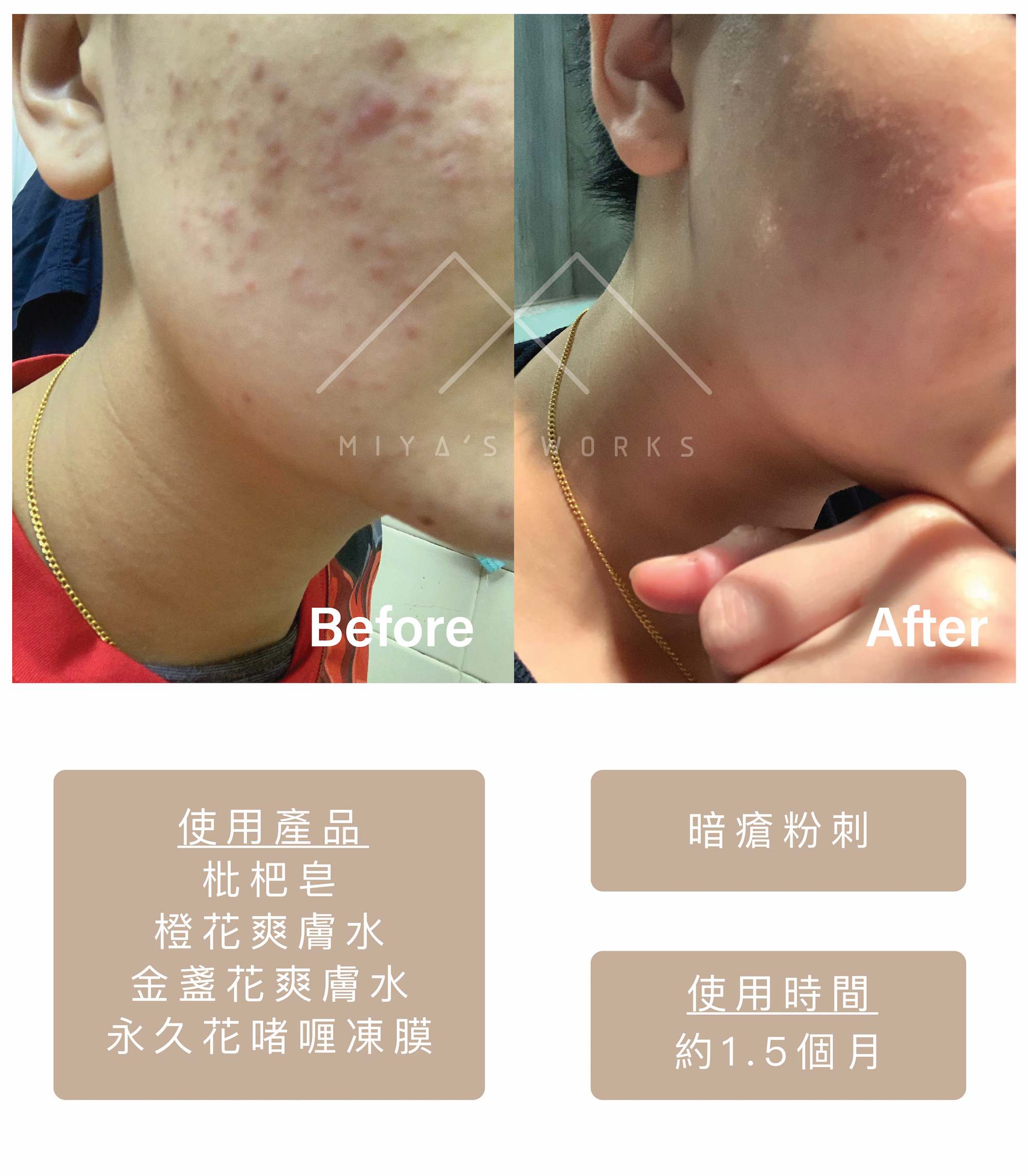 使用枇杷皂金盞花爽膚水消退暗瘡粉刺