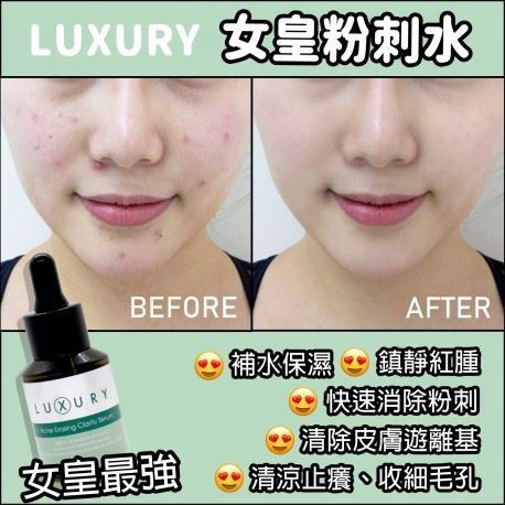 X Luxury 女皇奇蹟粉刺水 30ml