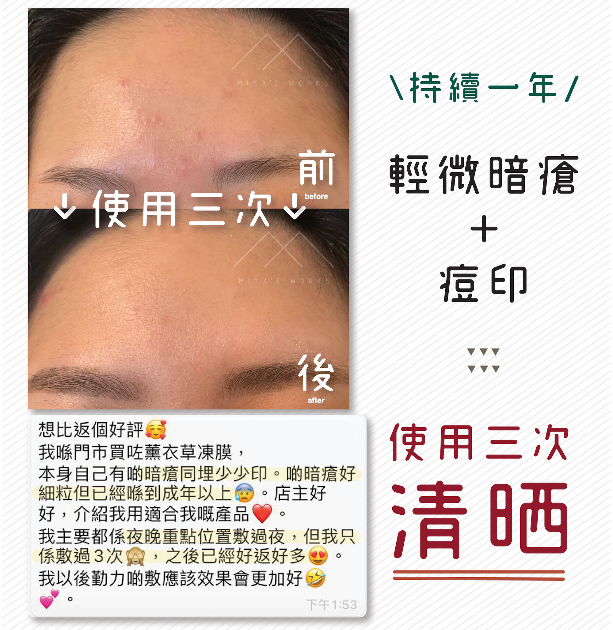 使用薰衣草凍膜極速清除持續一年的暗瘡及痘印問題