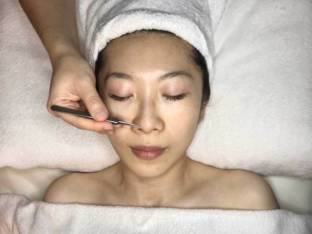 粉刺清除推薦療程