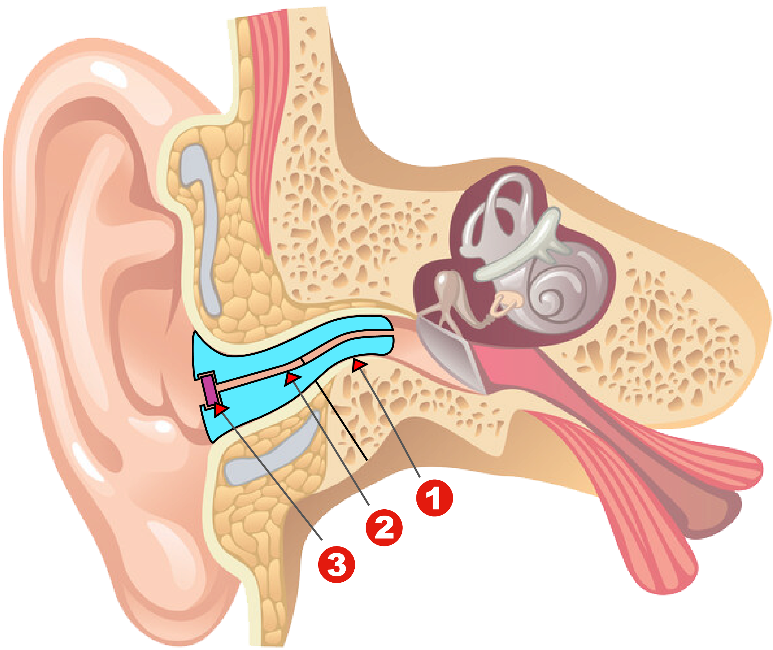 客製耳塞佩戴模擬