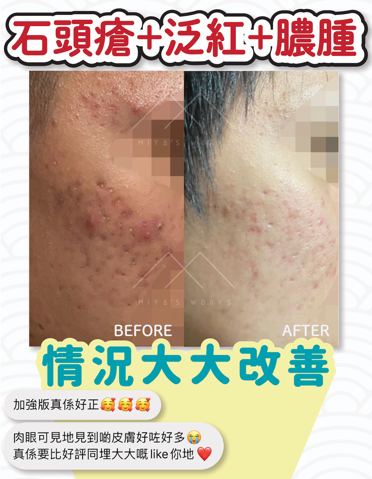 使用去痘去印套裝加強版改善石頭瘡泛紅膿腫問題