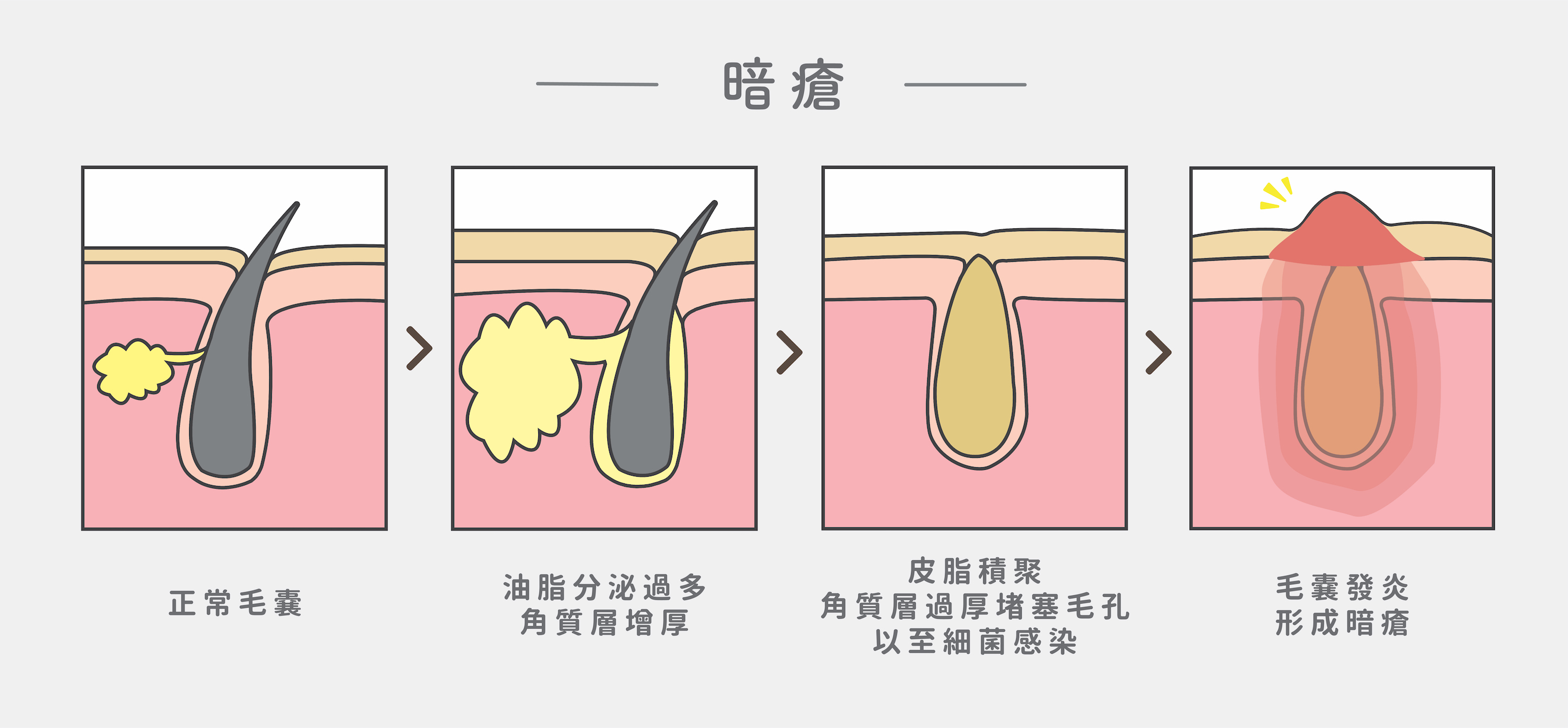 改善暗瘡系列 - Miya's Works 天然護膚品 香港人手製造