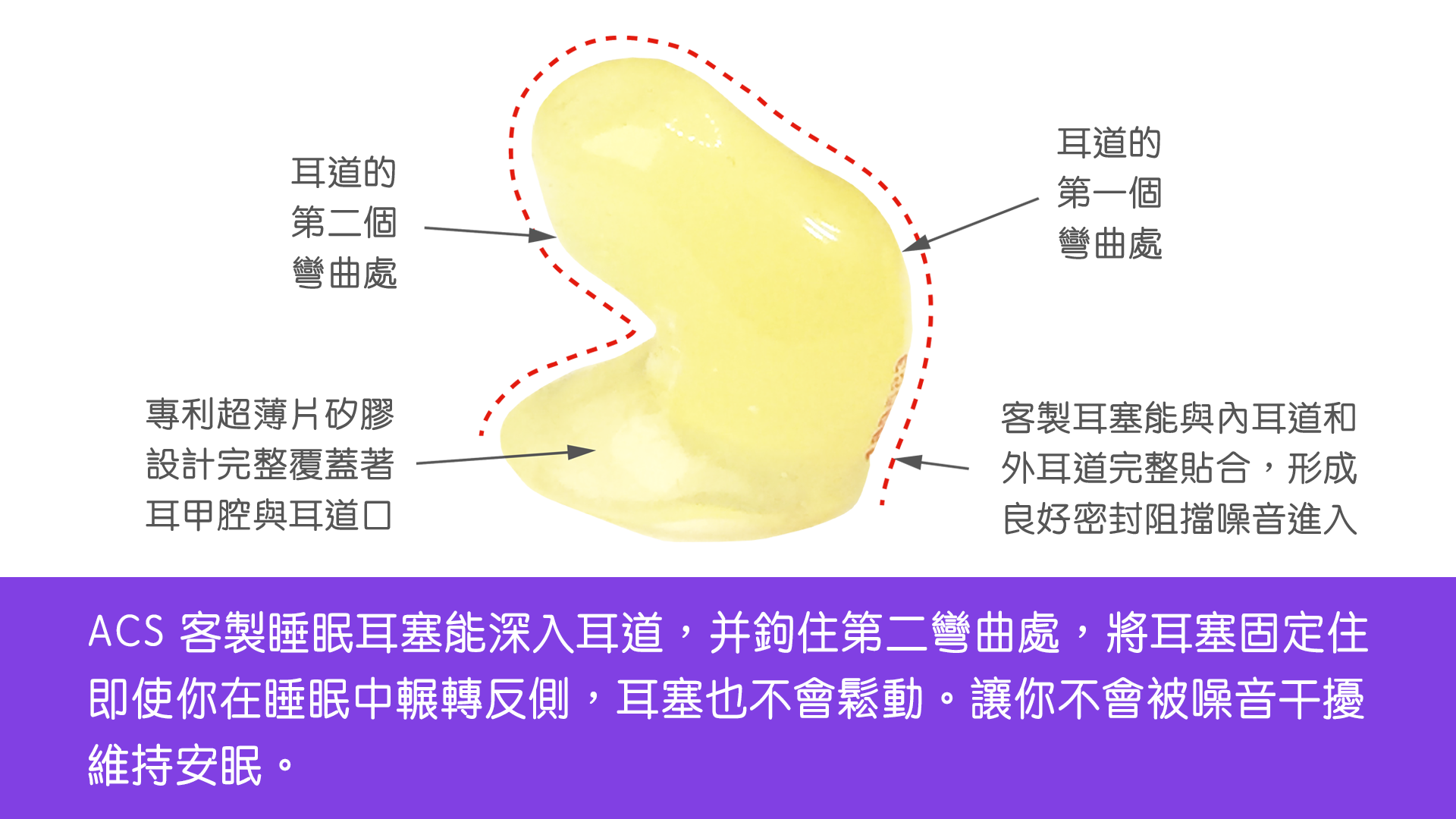 ACS 客製睡眠耳塞能深入耳道,并鉤住第二彎曲處,將耳塞固定住 即使你在睡眠中輾轉反側,耳塞也不會鬆動。讓你不會被噪音干擾 維持安眠。