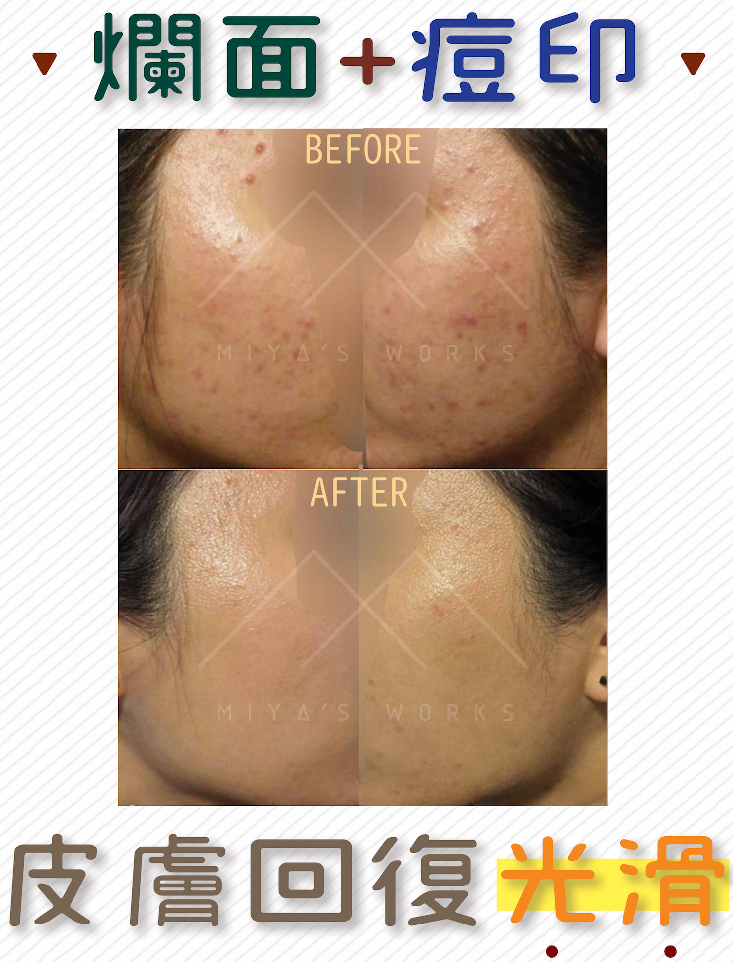 爛面及痘印也有辦法令皮膚回復光滑