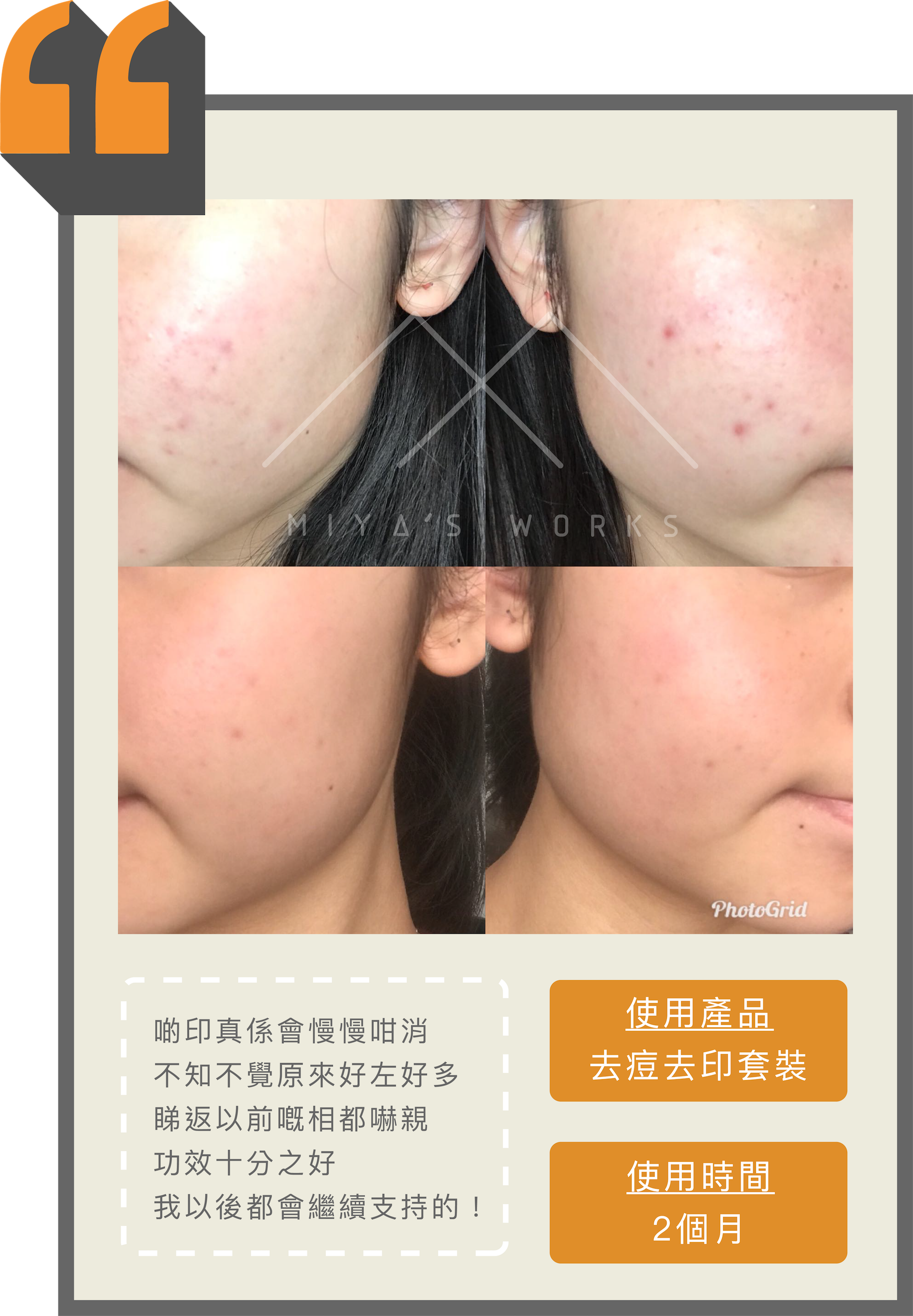 使用去痘去印套裝成功淡暗瘡印