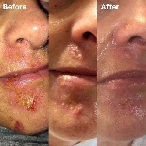 鱷魚油本身與人類皮膚親膚性高，而且含有豐富的Omega-3、6和9、罕有Omega 7 , 及維生素A ， C 和 E； 都是天然抗氧化劑、及皮膚癒合劑，能有效抑菌及抗炎