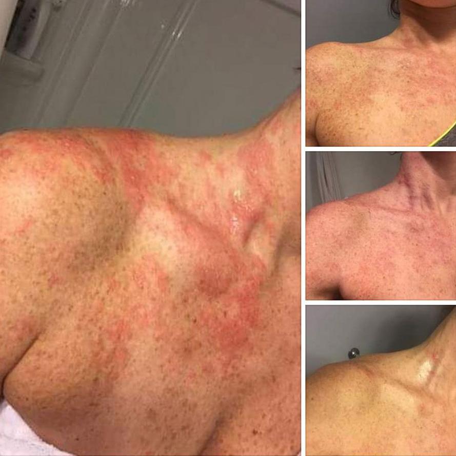 鱷魚油本身與人類皮膚親膚性高，而且含有豐富的Omega-3、6和9、罕有Omega 7 , 及維生素A ， C 和 E； 都是天然抗氧化劑、及皮膚癒合劑，能有效抑菌及抗炎