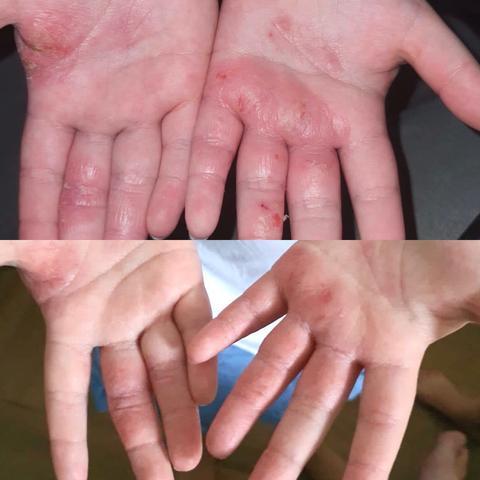 鱷魚油本身與人類皮膚親膚性高，而且含有豐富的Omega-3、6和9、罕有Omega 7 , 及維生素A ， C 和 E； 都是天然抗氧化劑、及皮膚癒合劑，能有效抑菌及抗炎