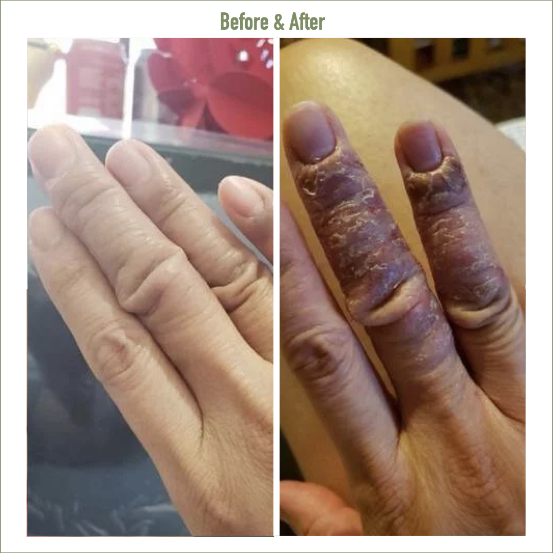 鱷魚油本身與人類皮膚親膚性高，而且含有豐富的Omega-3、6和9、罕有Omega 7 , 及維生素A ， C 和 E； 都是天然抗氧化劑、及皮膚癒合劑，能有效抑菌及抗炎