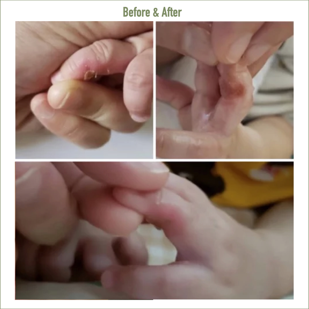 Golden8 Soothing Cream  ｜Golden 8 |  濕疹 ｜傷口救星 | 皮膚炎症 ｜皮膚敏感 ｜牛皮癬｜ 紅疹 ｜皮膚痕癢 ｜痕癢肌 ｜乾燥肌 ｜ 天然成份 ｜中西醫推介 ｜無藥性 ｜不含類固醇 ｜修復濕敏肌 ｜網紅推介