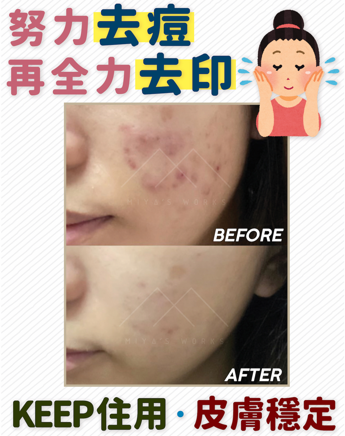 薰衣草,永久花,暗瘡,背痘,痕癢,過敏,口罩,了解自己的膚質,膚質,油性,乾燥,面油,皮膚問題,混合性肌膚,T字位,毛孔阻塞,暗瘡,黑頭粉刺,毛孔粗大,乾燥,細紋,敏感,多餘油脂