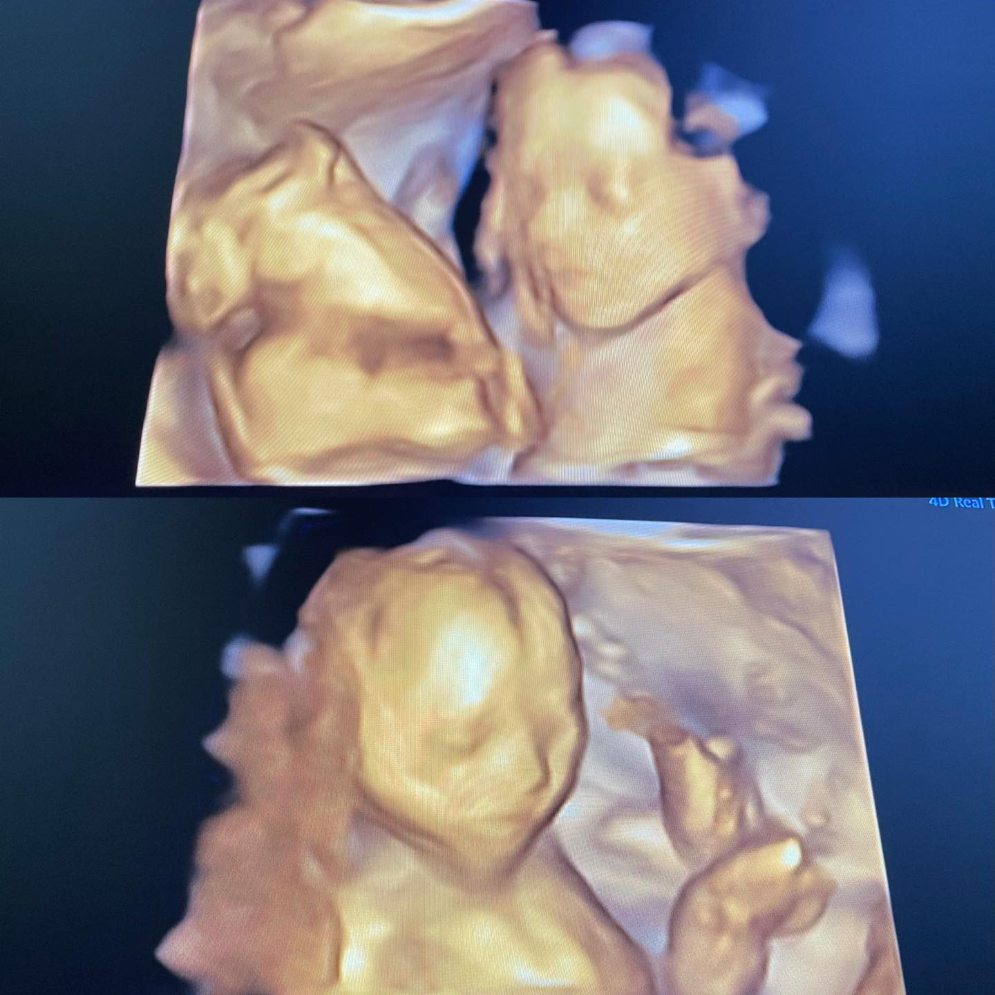 肉粽寶寶超音波照片