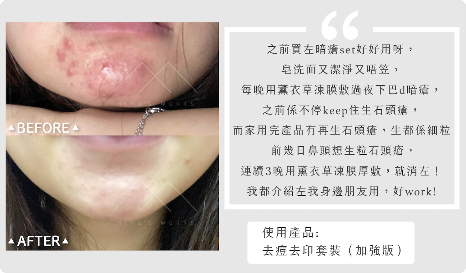 去痘去印套裝（加強版）