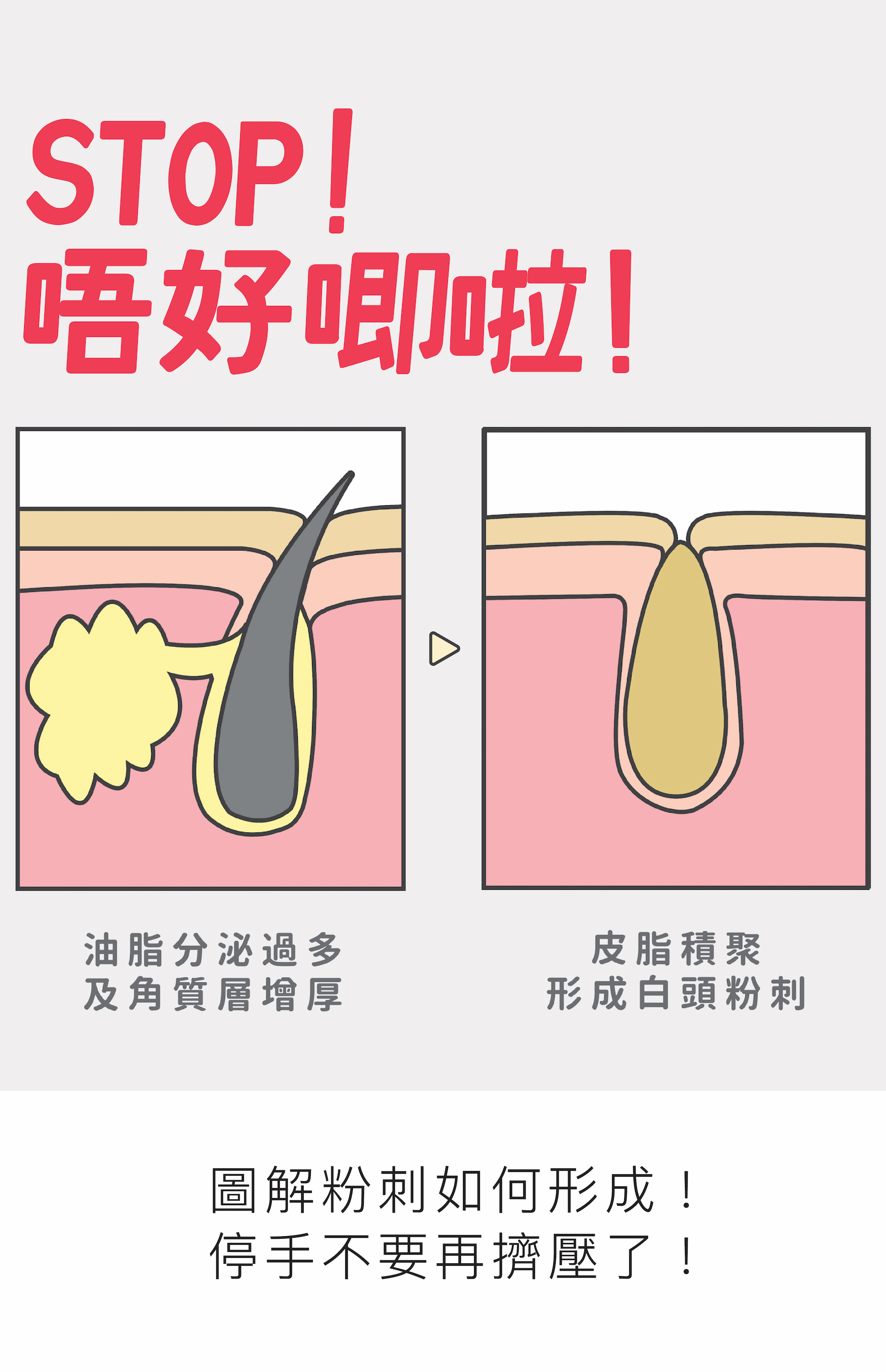 圖解粉刺如何形成