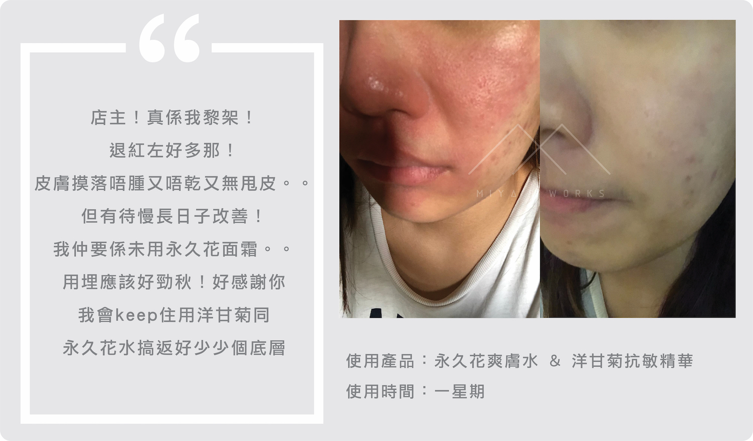 使用永久花爽膚水洋甘菊精華改善泛紅皮膚回復平滑