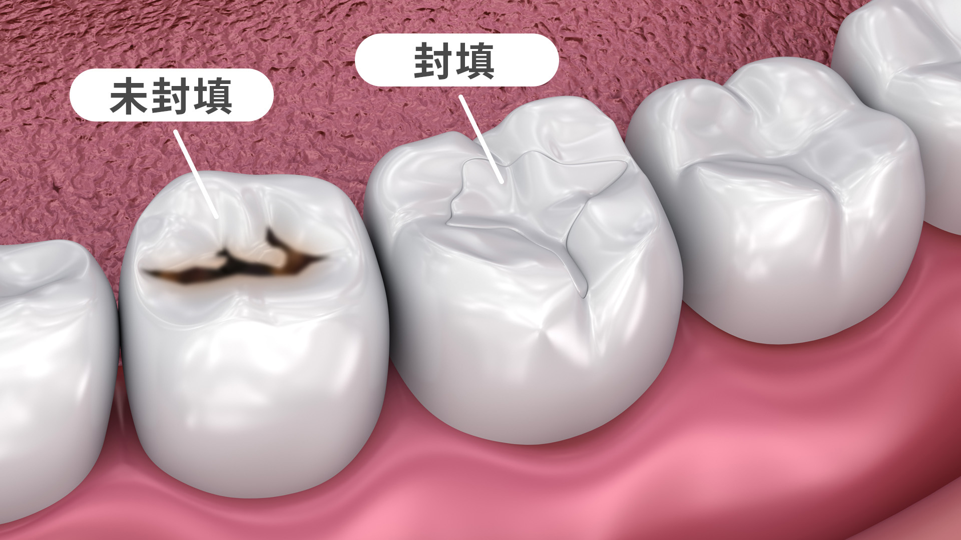 齒溝封填