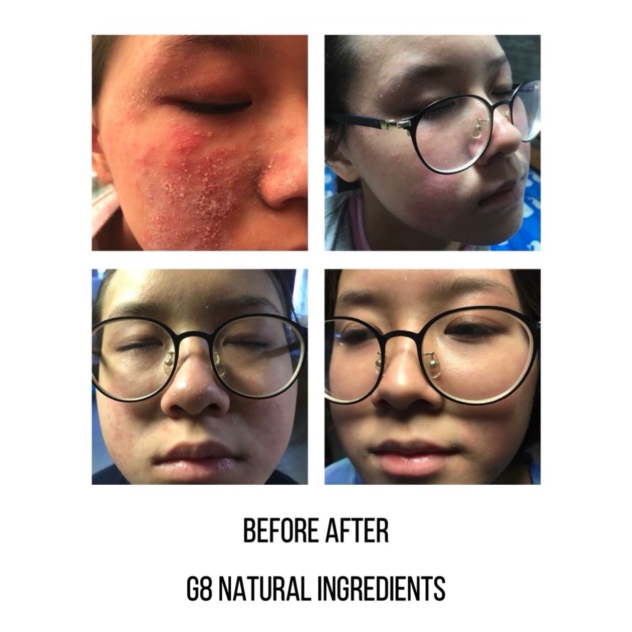 濕疹敏感肌救星 鱷魚油呵護敏弱肌膚