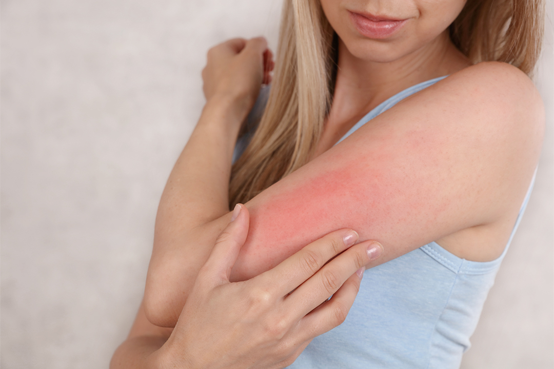 換季,換季保養,敏感肌,泛紅