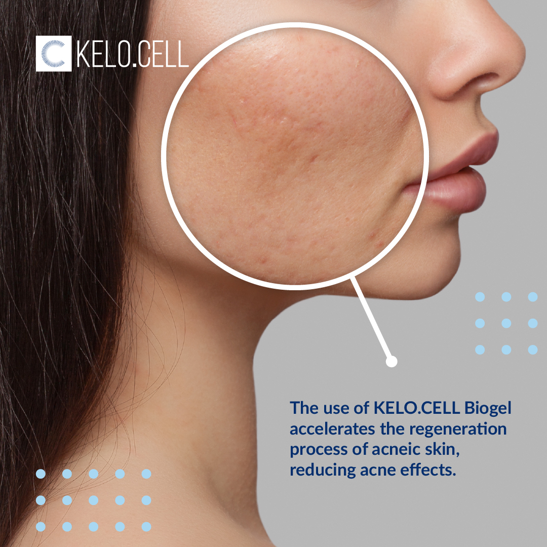 The use of KELO.CELL Biogel accelerates the regeneration process of acneic skin, reducing acne effects.