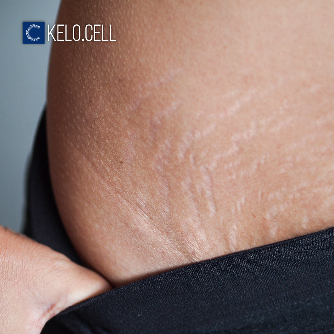 KELO CELL Biogel - Stretch marks