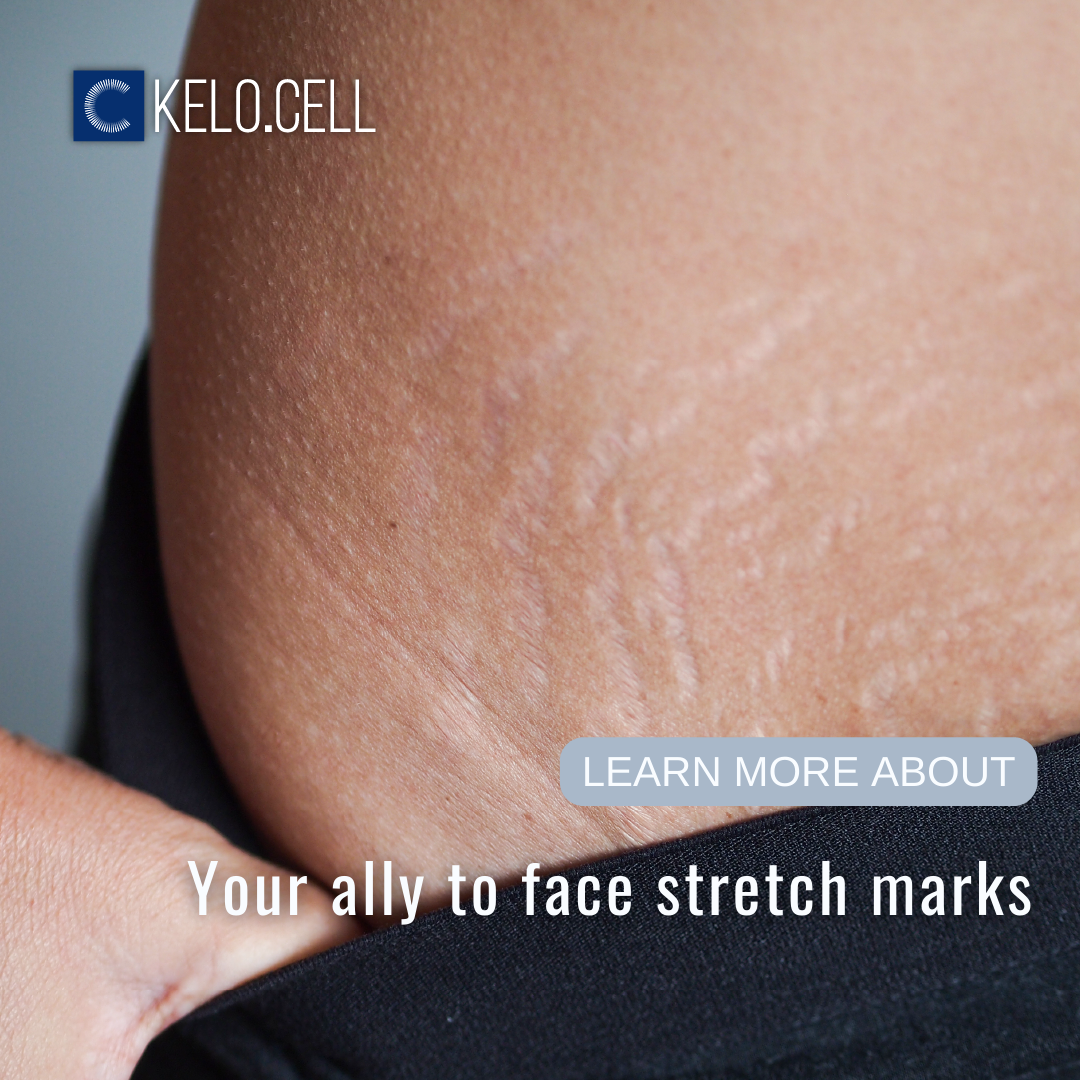KELO CELL Biogel - Stretch marks