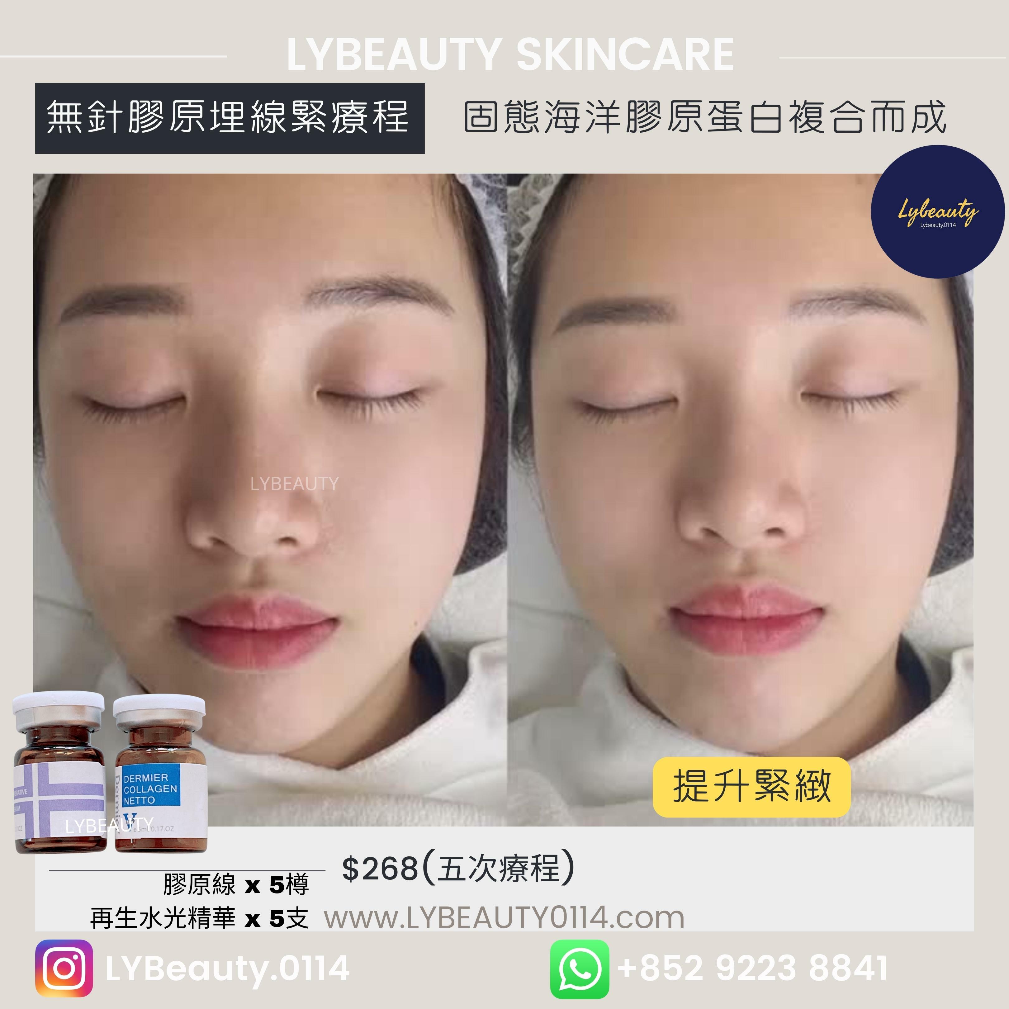 再生面部小顏緊緻提升療程（一盒五套 膠原線）