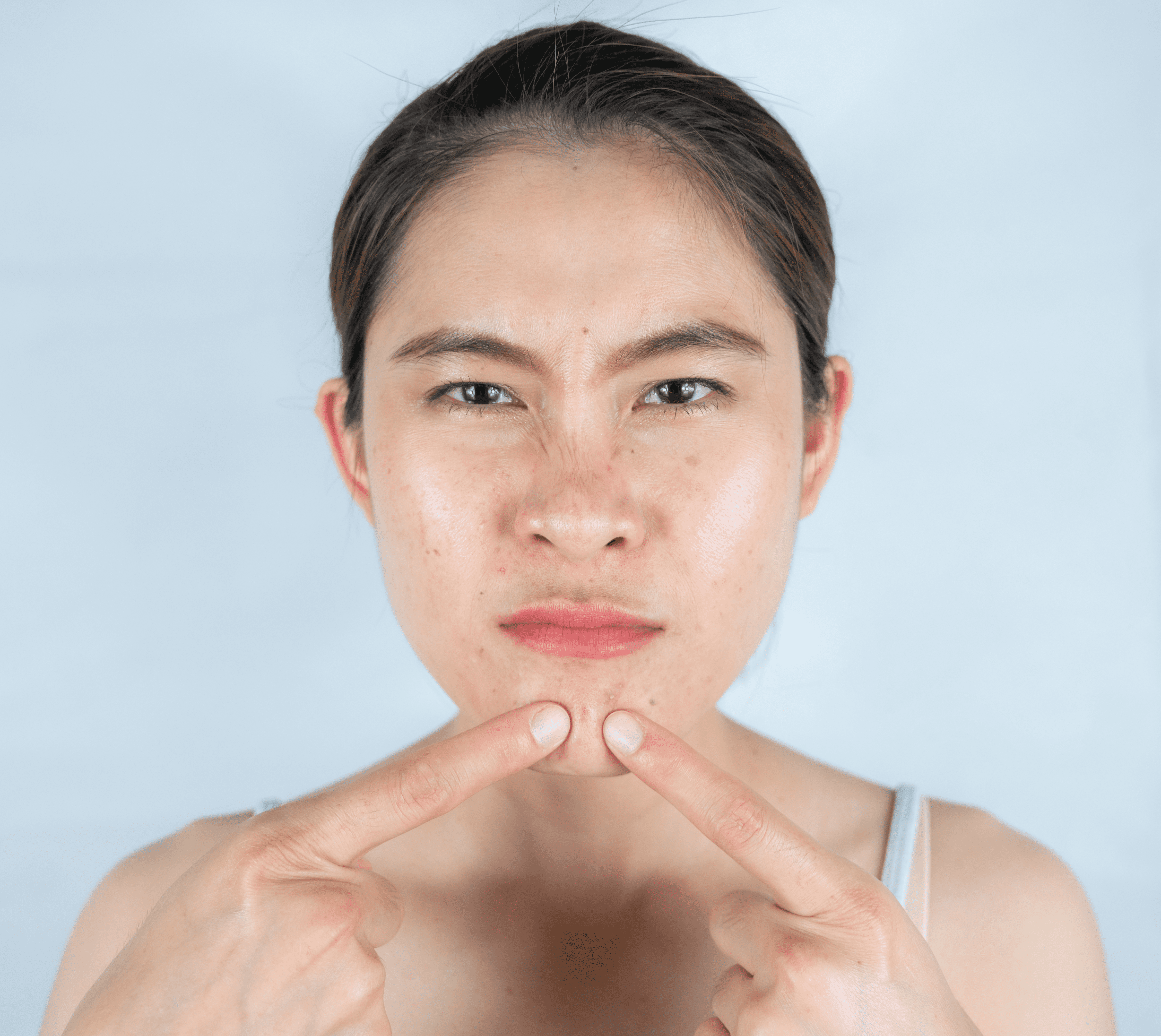 油痘肌保養須知：解決毛孔粗大與粉刺痘痘問題