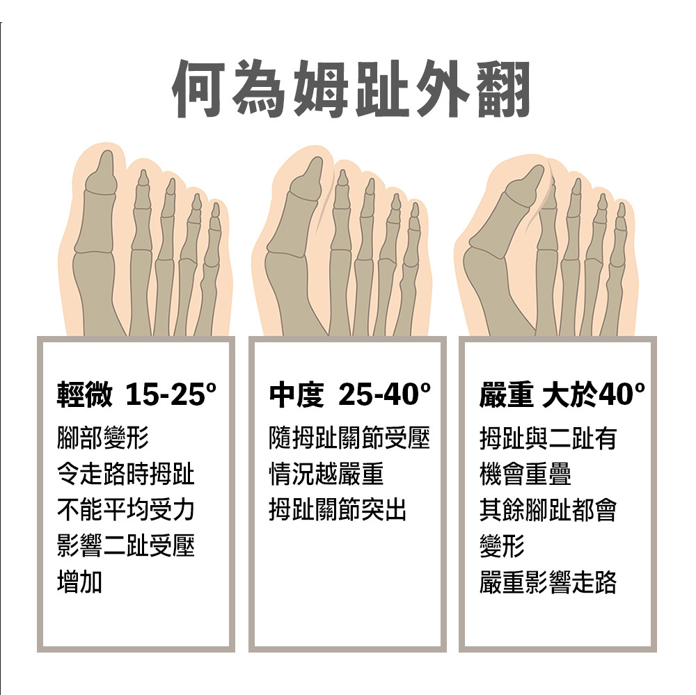 拇趾外翻矯正固定墊 - 1對