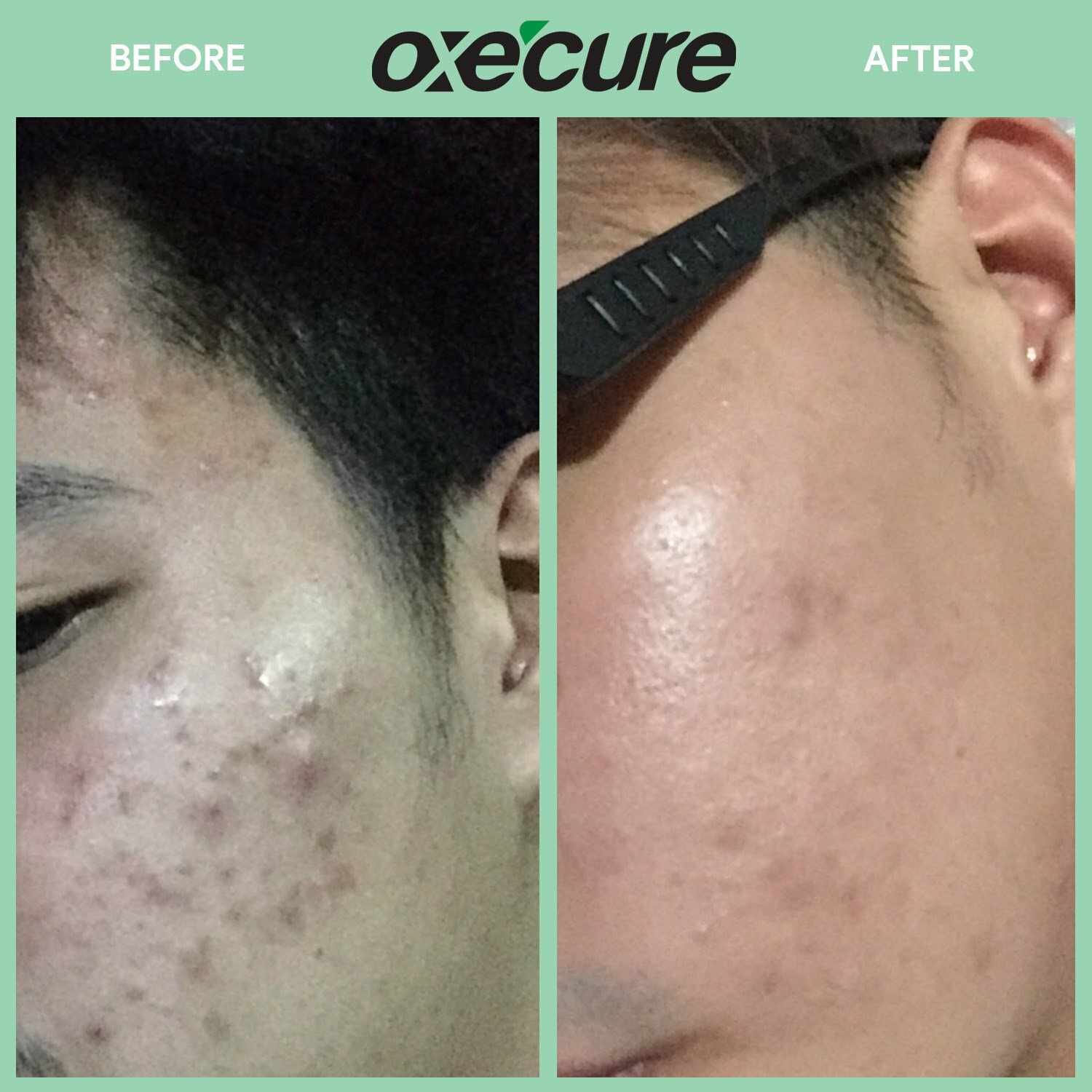 泰國 OXECURE 消炎暗瘡水 10ML