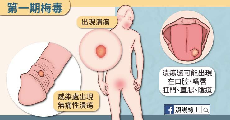 梅毒初期症狀是：身體會出現無痛的潰瘍，而且會在6星期康復。出現的位置在性器官或口腔中比較多。123