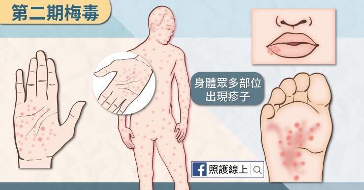 梅毒症狀也會發展成：頭痛、感冒、發燒等讓人以為是普通疾病，因此錯過最佳治療梅毒的時機。
