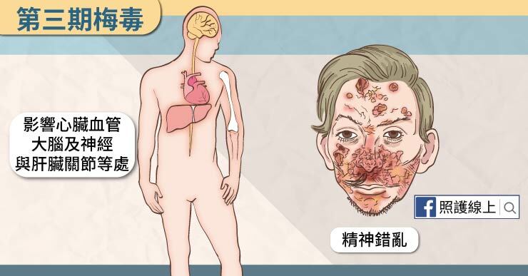 梅毒後期會侵入人類大腦和器官，讓人神志不清，甚至引發心臟病，非常可怕
