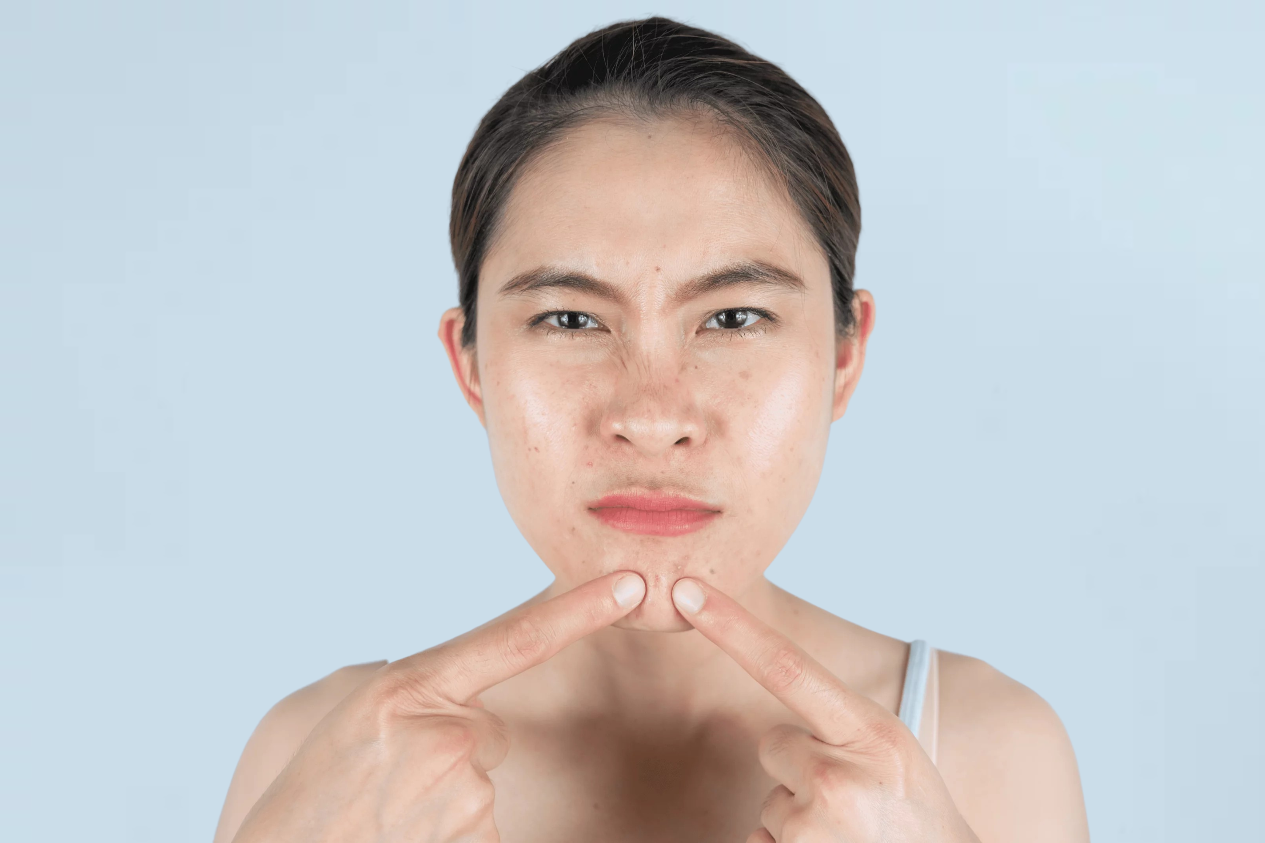 油痘肌保養須知：長期爆痘好煩惱？3大痘痘、毛孔保養處理方法