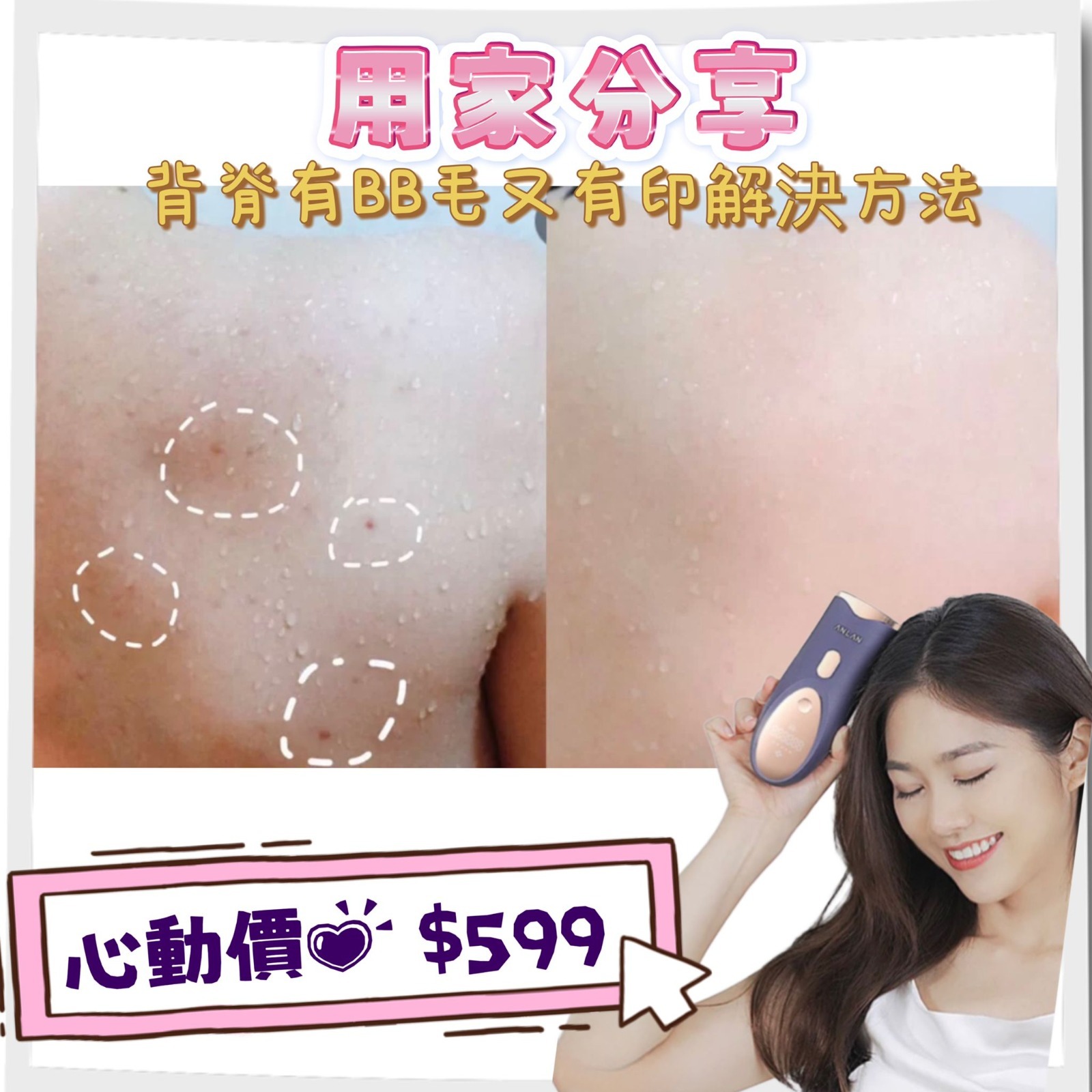 日本ANLAN 4合1美肌嫩膚脫毛機