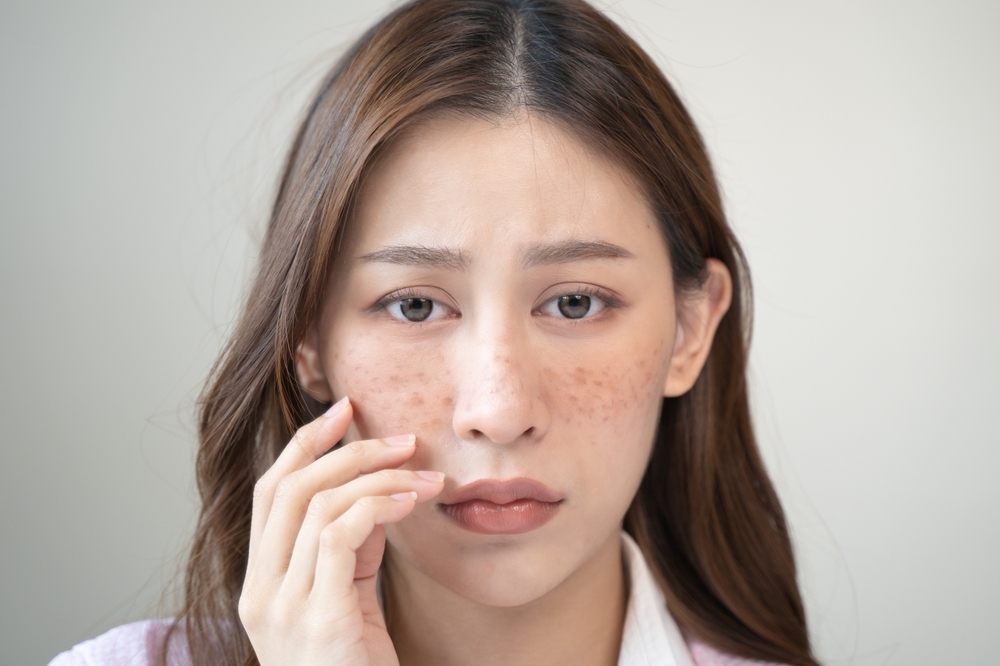 皮膚黑色素沉澱怎麼辦?3大保養方法,讓你臉上不再掛著「點點點」