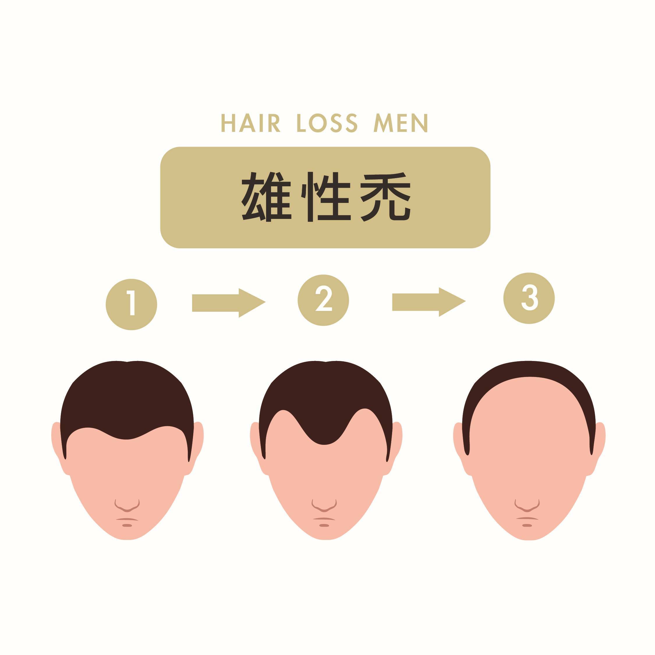 男性禿頭通常從前額髮際線開始，進而呈現M字型慢慢向後退