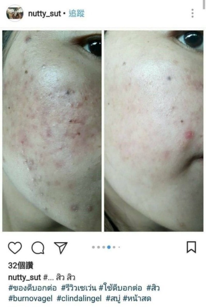 現貨 泰國 Clindalin Gel 祛痘平痘精華凝膠 10g 抗痘去粉刺 爆紅痘痘藥膏