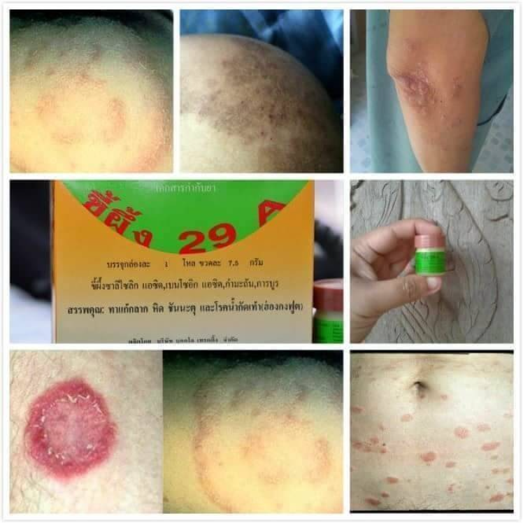 現貨 泰國 29A 癬藥膏 7.5g｜日常癬類不適・足癬股癬護理