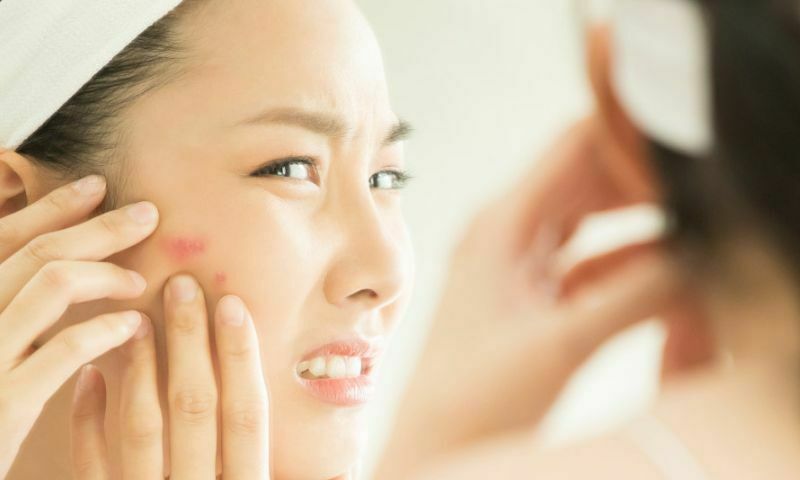 痘痘肌保養3大步驟，養出水煮蛋肌，讓你告別痘痘人生