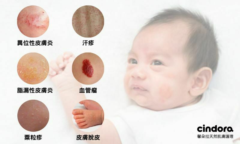 寶寶常見皮膚狀況！四大必知呵護方法