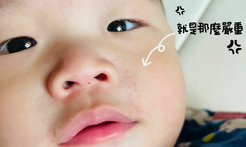 異膚寶寶用什麼都不對？三大方法教你照顧異膚寶寶