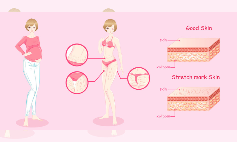認識皮膚擴張紋 Stretch mark：一秒搞妊娠紋、生長紋與肥胖紋