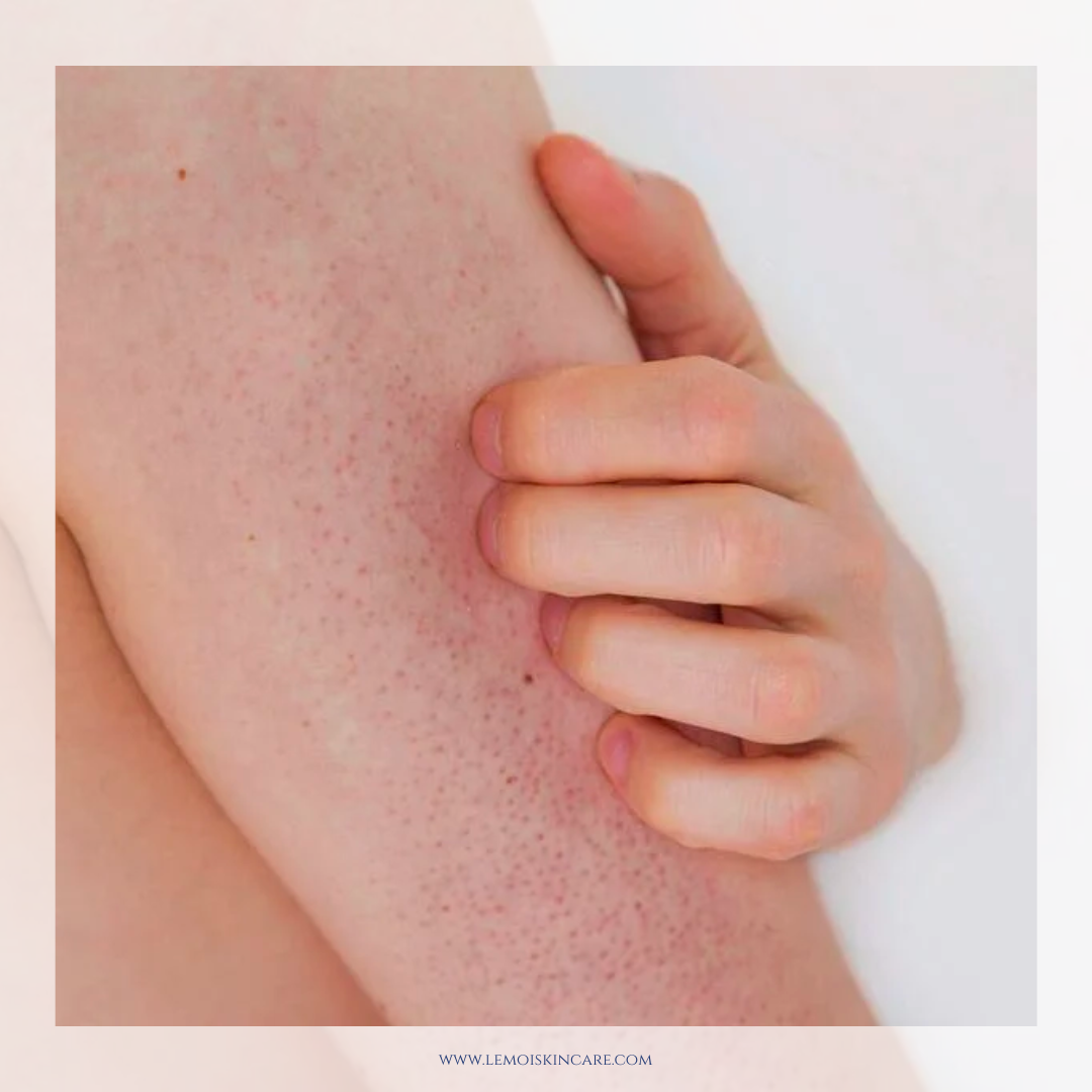 苦楝山茶花角質修護手工皂｜臭臭皂（毛囊角化症專用）