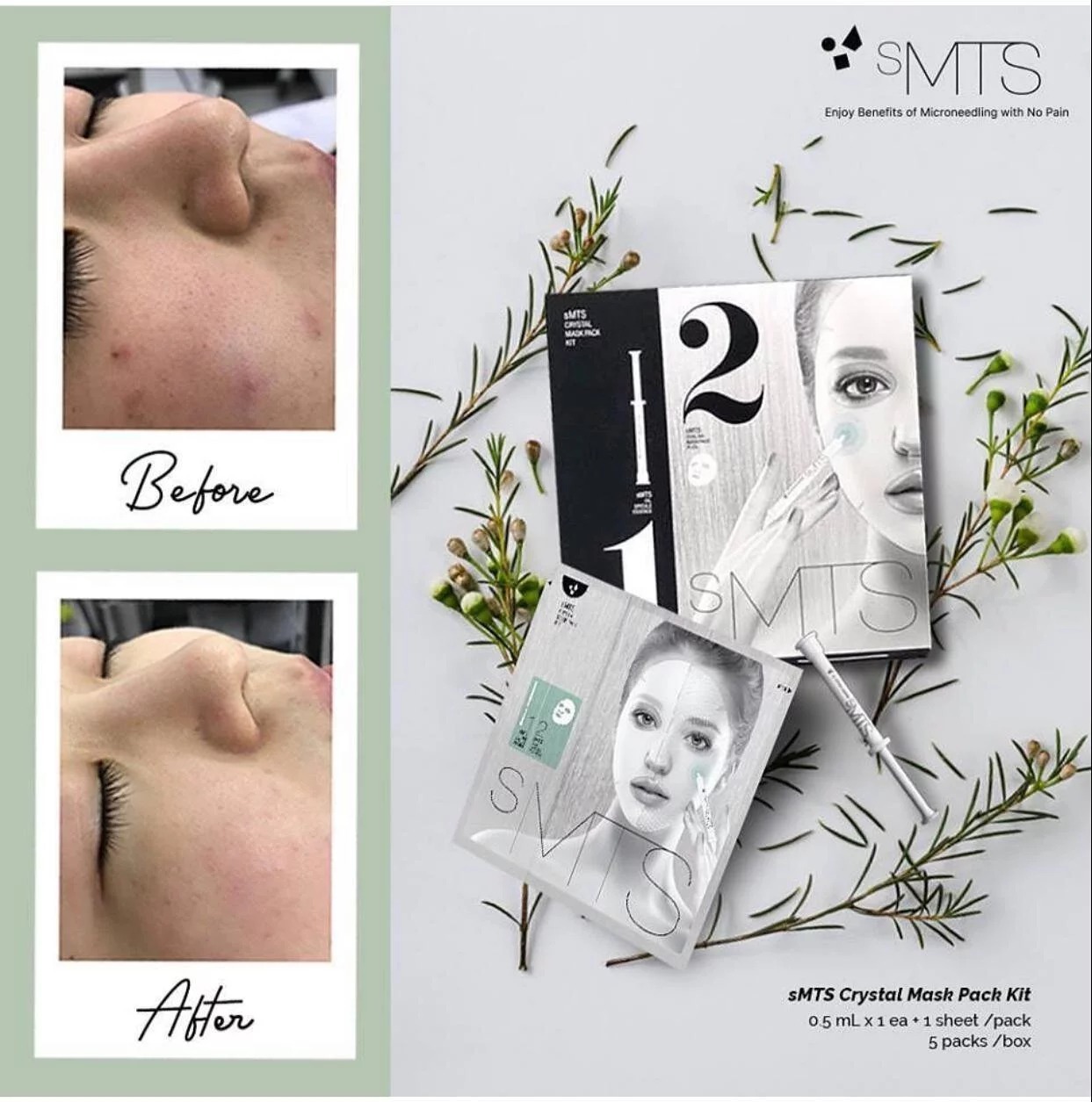 sMTS - 水光粒子（家用版嬰兒針) 1盒5套 ( 2盒再優惠)★