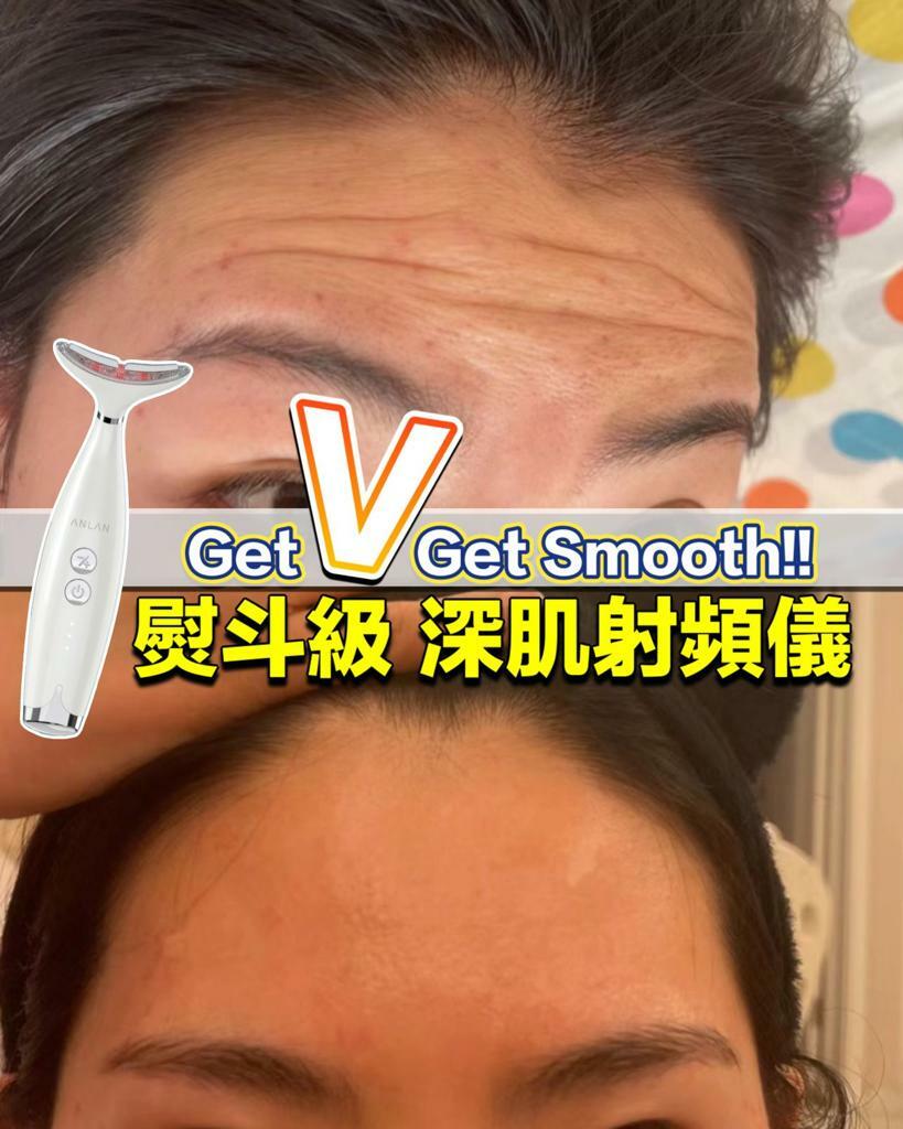 日本🇯🇵ANLAN 破壁深肌埋線射頻機