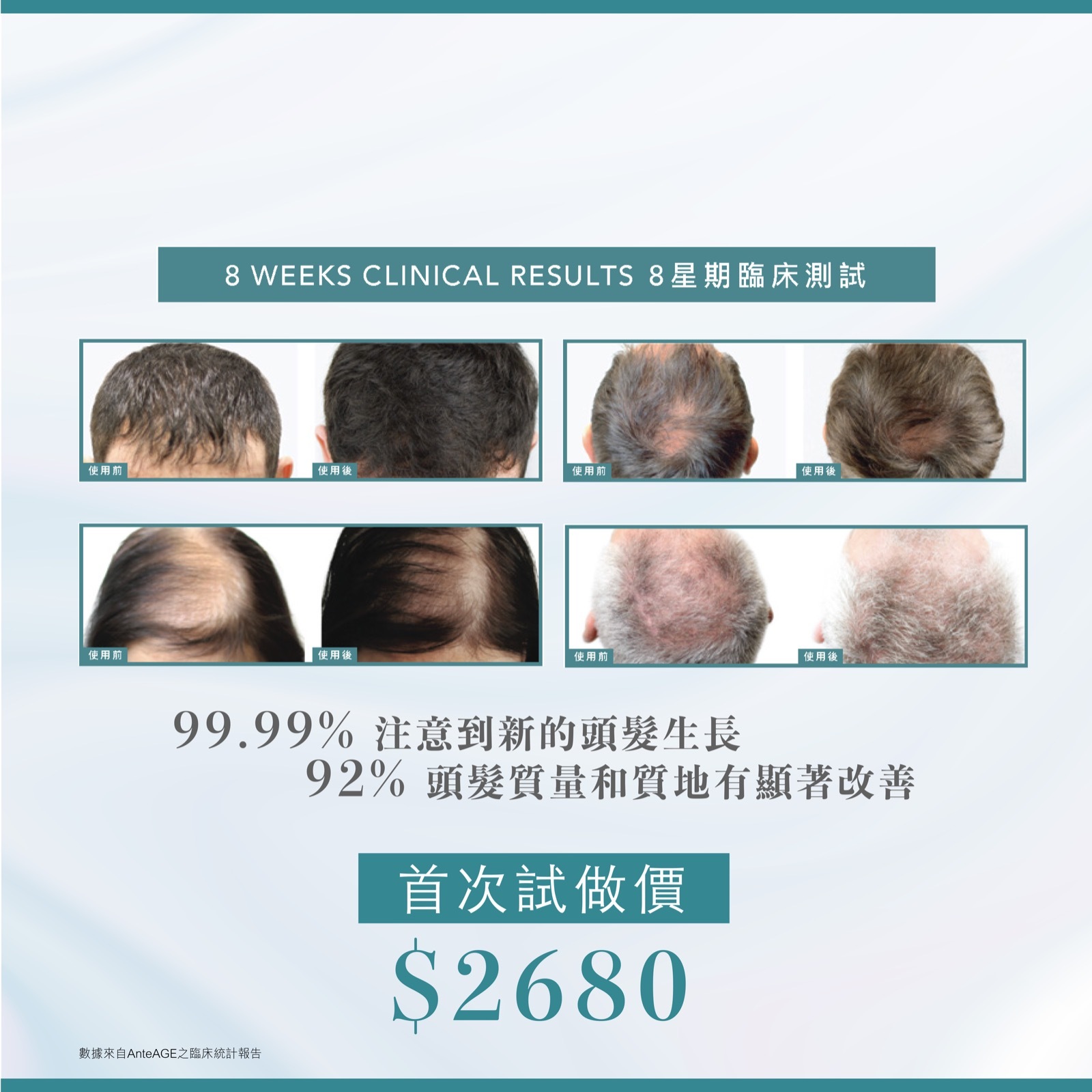 美國AnteAGE醫學級重新活髮微針療程